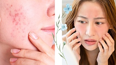 تفاوت بین لک ناشی از آفتاب و لک هورمونی