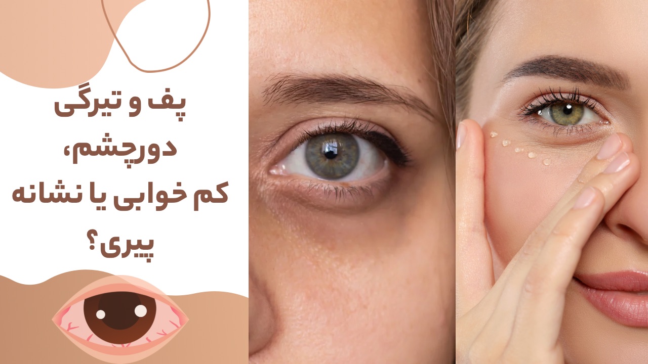 علت پف و تیرگی دورچشم و راه درمان آن