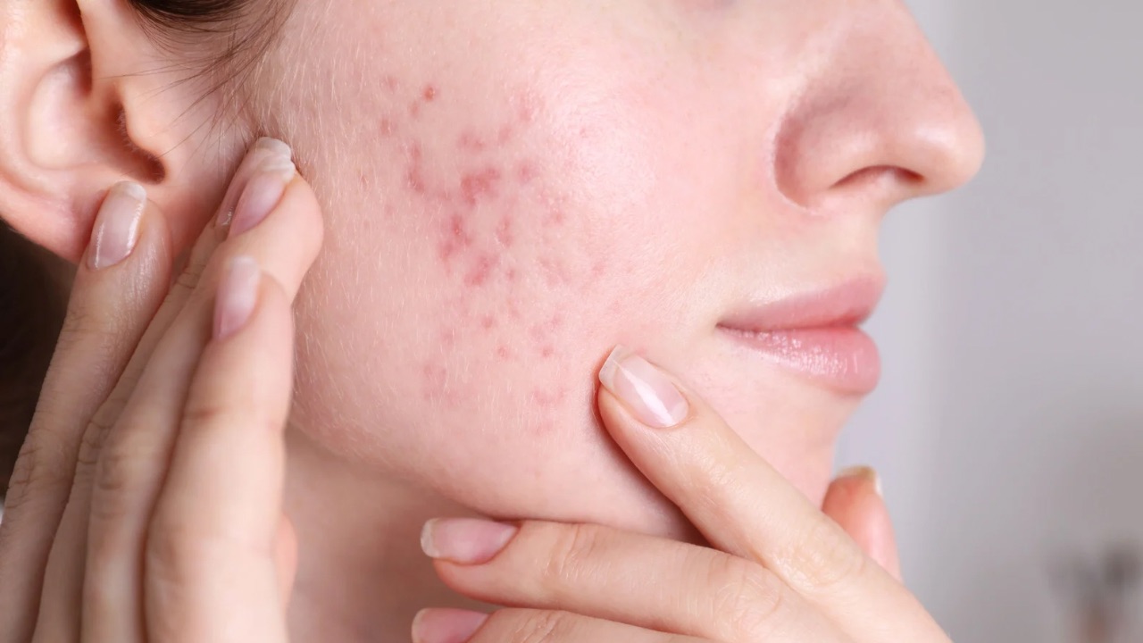 کرم ضدلک جای جوش