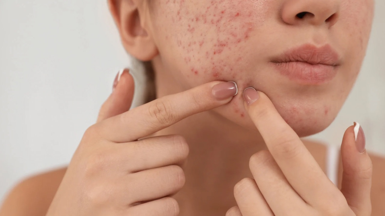 کرم ضدلک جای جوش قوی