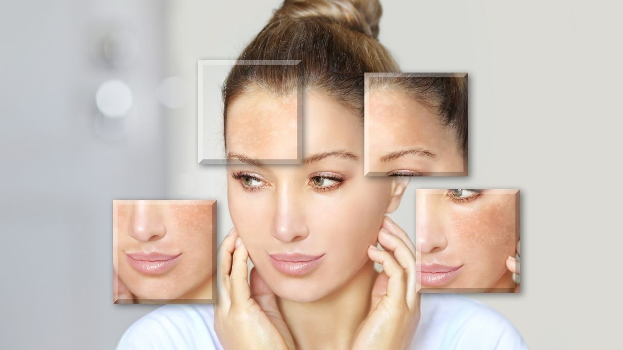 بهترین کرم برای لک ملاسما