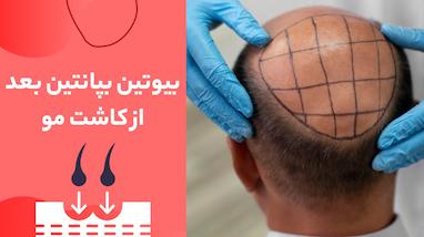 بیوتین بپانتین بعد از کاشت مو؛ چه زمانی و چگونه استفاده کنیم؟