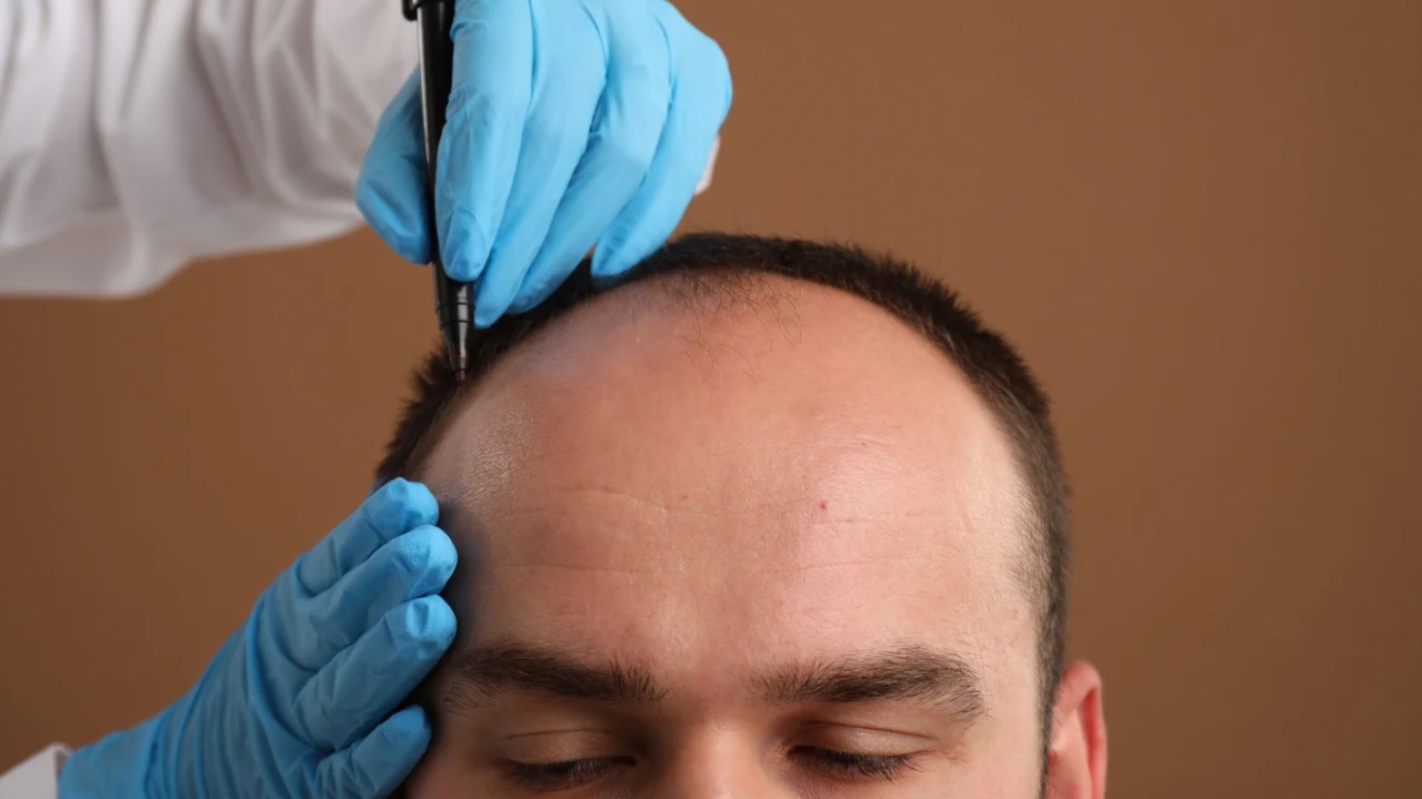 بیوتین بعد از کاشت مو